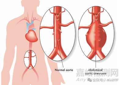 【創(chuàng)新醫(yī)械】A3-Shield：抑制腹主動脈瘤增長的支架，從根本上解決AAA