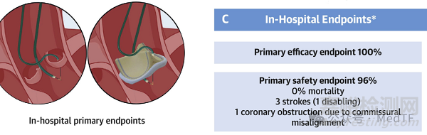 【創(chuàng)新醫(yī)械】Telltale：新型電外科導(dǎo)絲獲FDA批準(zhǔn)上市，在TAVI術(shù)中預(yù)防冠狀動脈阻塞
