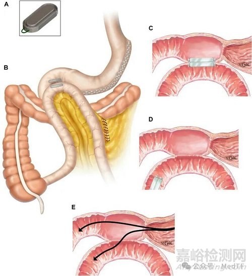 【創(chuàng)新醫(yī)械】MagDI：磁性吻合器，90天減重10%