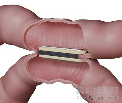 【創(chuàng)新醫(yī)械】MagDI：磁性吻合器，90天減重10%