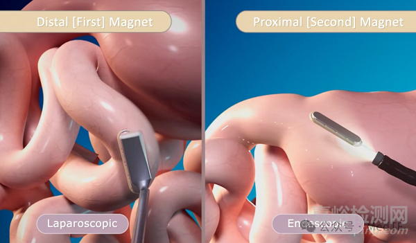 【創(chuàng)新醫(yī)械】MagDI：磁性吻合器，90天減重10%
