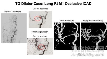 【創(chuàng)新醫(yī)械】TG dilator:可取出的顱內(nèi)支架