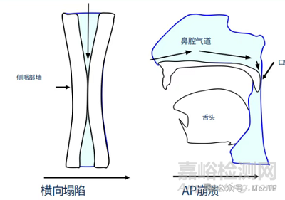 【創(chuàng)新醫(yī)械】Somnair:可以治療打鼾的“隱形牙套”
