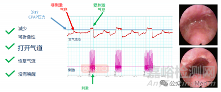 【創(chuàng)新醫(yī)械】Somnair:可以治療打鼾的“隱形牙套”