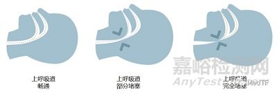 【創(chuàng)新醫(yī)械】Somnair:可以治療打鼾的“隱形牙套”