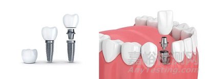 牙種植體注冊分類與適用標(biāo)準(zhǔn)