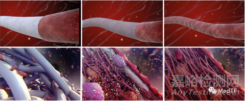 aXess:可再生人工血管一年通暢率為100%