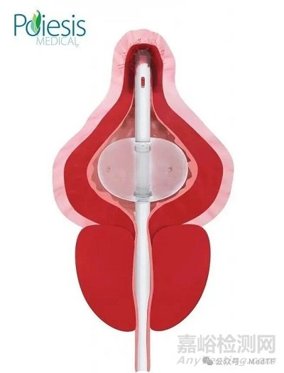 【創(chuàng)新醫(yī)械】Duette：雙球囊導(dǎo)尿管，解決尿路感染