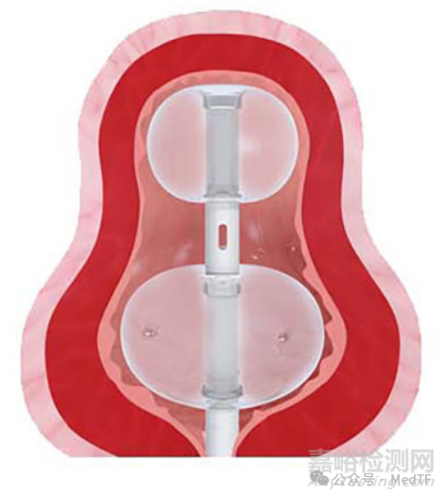 【創(chuàng)新醫(yī)械】Duette：雙球囊導(dǎo)尿管，解決尿路感染