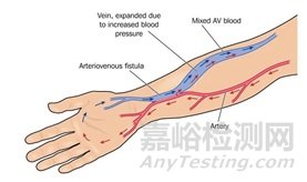血管通路醫(yī)療器械技術(shù)、產(chǎn)品與市場分析