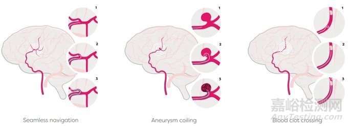 【創(chuàng)新醫(yī)械】SmartGUIDE：實時可調(diào)彎神經(jīng)介入導(dǎo)絲獲批上市