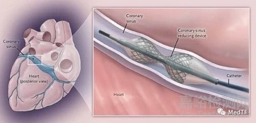 強(qiáng)生發(fā)布心絞痛支架臨床數(shù)據(jù)