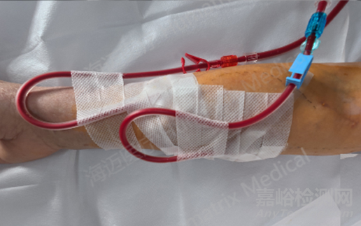 國產(chǎn)首款完全生物型小口徑人工血管技術(shù)解析