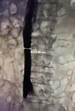 提高傘形腔靜脈濾器回收率的關(guān)鍵要素