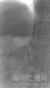 提高傘形腔靜脈濾器回收率的關(guān)鍵要素