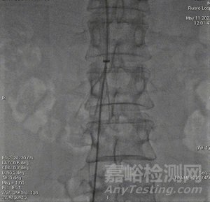 提高傘形腔靜脈濾器回收率的關(guān)鍵要素