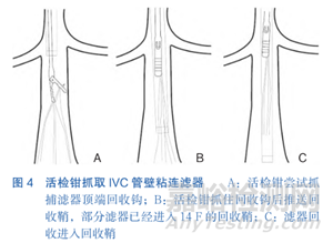 提高傘形腔靜脈濾器回收率的關(guān)鍵要素