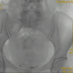 提高傘形腔靜脈濾器回收率的關(guān)鍵要素