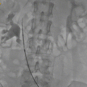 提高傘形腔靜脈濾器回收率的關(guān)鍵要素