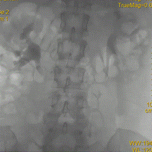 提高傘形腔靜脈濾器回收率的關(guān)鍵要素