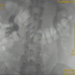 提高傘形腔靜脈濾器回收率的關(guān)鍵要素