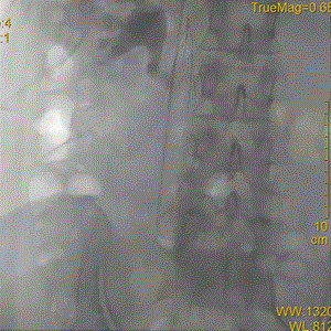 提高傘形腔靜脈濾器回收率的關(guān)鍵要素