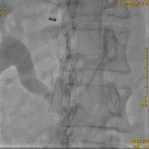 提高傘形腔靜脈濾器回收率的關(guān)鍵要素