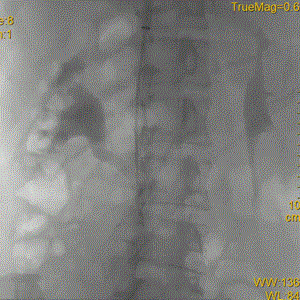 提高傘形腔靜脈濾器回收率的關(guān)鍵要素