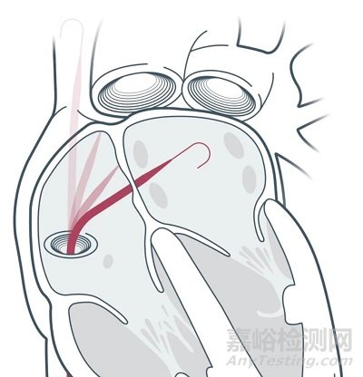 【創(chuàng)新醫(yī)械】首款“零交換+阻抗引導”經(jīng)房間隔通路系統(tǒng)獲批FDA