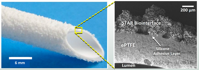 新型膨體聚四氟乙烯ePTFE人工血管臨床研究結(jié)果公布