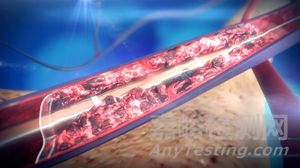 全球血栓清除醫(yī)療器械技術(shù)、產(chǎn)品與市場分析