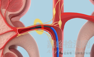 邁微醫(yī)療創(chuàng)新醫(yī)械muRDN腎動(dòng)脈超聲神經(jīng)消融系統(tǒng)技術(shù)解析