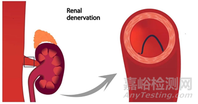邁微醫(yī)療創(chuàng)新醫(yī)械muRDN腎動(dòng)脈超聲神經(jīng)消融系統(tǒng)技術(shù)解析