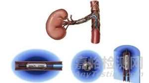 邁微醫(yī)療創(chuàng)新醫(yī)械muRDN腎動(dòng)脈超聲神經(jīng)消融系統(tǒng)技術(shù)解析