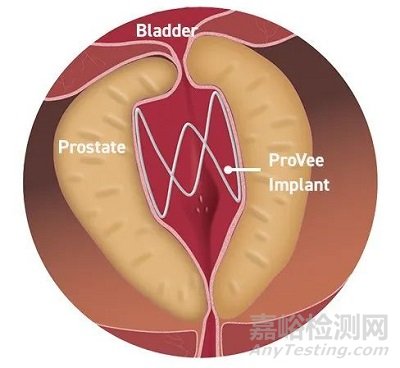 ProVee:自膨脹BPH支架獲FDA批準(zhǔn)上市