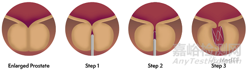 ProVee:自膨脹BPH支架獲FDA批準(zhǔn)上市