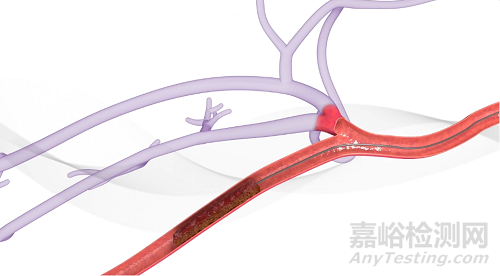 美敦力Liberant外周血栓切除系統(tǒng)技術(shù)解析