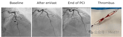 【創(chuàng)新醫(yī)械】全球唯一冠脈取栓支架enVast獲批FDA