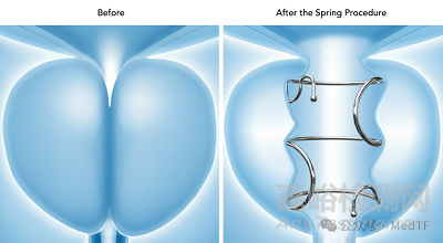 【創(chuàng)新醫(yī)械】可取出前列腺支架Zenflow Spring獲批FDA
