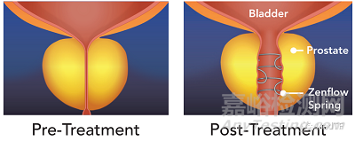 【創(chuàng)新醫(yī)械】可取出前列腺支架Zenflow Spring獲批FDA