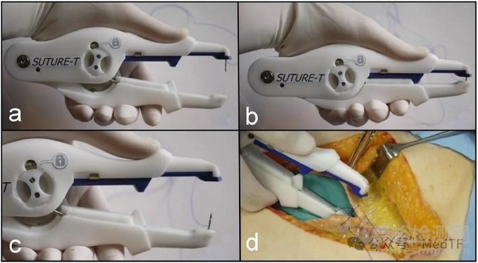 【創(chuàng)新醫(yī)械】Suture-TOOL：革命性腹部縫合器獲批上市，讓縫合標(biāo)準(zhǔn)化