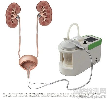 【創(chuàng)新醫(yī)械】JuxtaFlow輸尿管支架讓尿排量增加70%，減少急性失代償性心衰患者住院