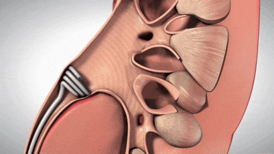 【創(chuàng)新醫(yī)械】JuxtaFlow輸尿管支架讓尿排量增加70%，減少急性失代償性心衰患者住院