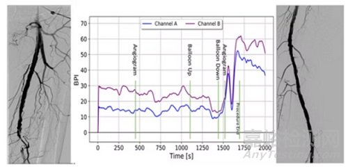 全球首款實(shí)現(xiàn)基于定量指數(shù)的實(shí)時(shí)深層組織灌注監(jiān)測(cè)設(shè)備