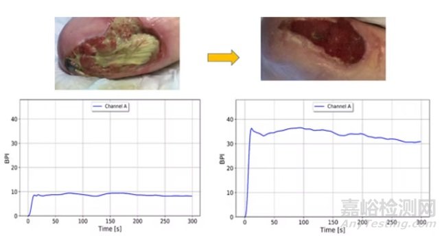 全球首款實(shí)現(xiàn)基于定量指數(shù)的實(shí)時(shí)深層組織灌注監(jiān)測(cè)設(shè)備