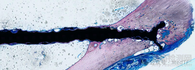 可吸收鎂合金骨折板獲FDA“突破性設備認定”