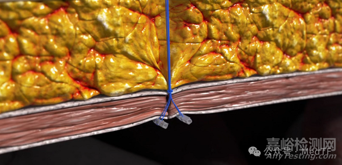 帶縫合功能的腹腔鏡穿刺器獲批FDA，零切口疝發(fā)生率