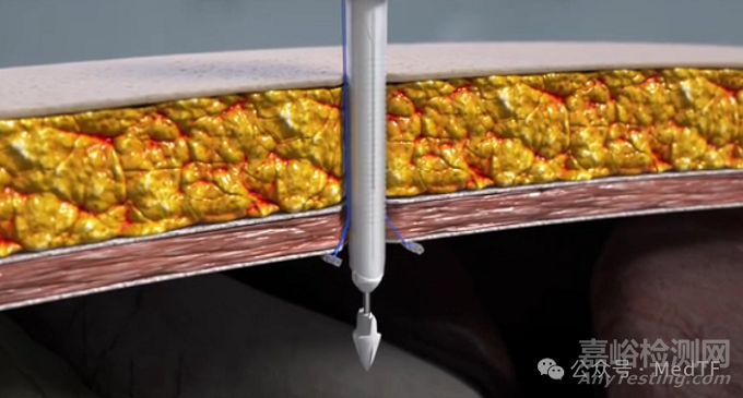 帶縫合功能的腹腔鏡穿刺器獲批FDA，零切口疝發(fā)生率