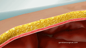 帶縫合功能的腹腔鏡穿刺器獲批FDA，零切口疝發(fā)生率