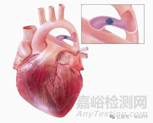 Amplatzer Piccolo：雅培封堵器輸送系統(tǒng)同時(shí)獲FDA和CE批準(zhǔn)上市